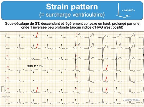 strain pattern ecg